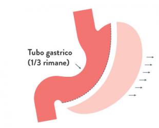 Sleeve gastrectomy (gastrectomia longitudinale)