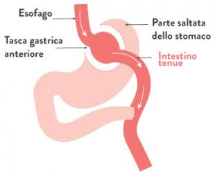 Bypass gastrico
