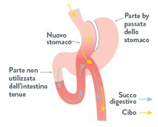 Mini Bypass Gastrico 