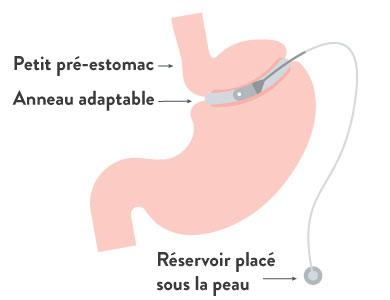 L’anneau gastrique (gastric banding)
