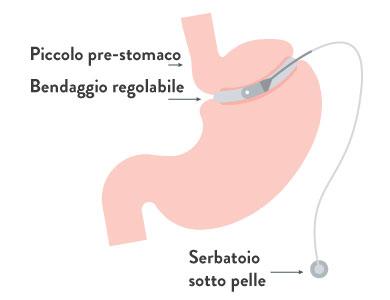 Il bendaggio gastrico (gastric banding)