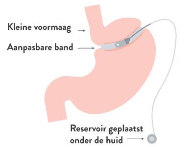 Maagband (gastric banding)