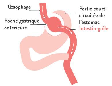 La dérivation gastrique (gastric bypass)