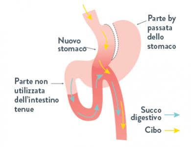 Mini Bypass Gastrico 