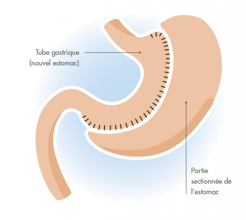 Sleeve (gastrectomie longitudinale) Barinutrics