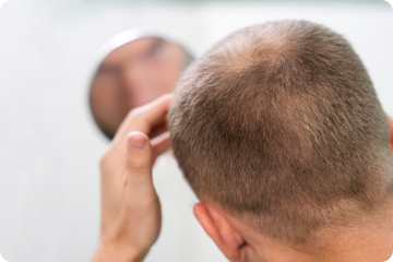 Haarverlies - Hair Loss - Haaruitval - Barinutrics Hair